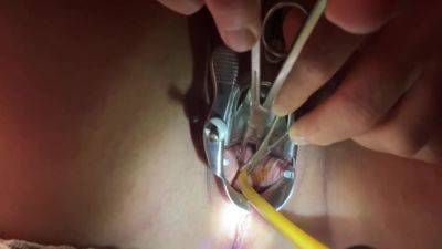 Tenaculum Grasping Cervix For Catheter 7 Min on vidgratis.com